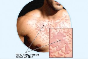 Macchie sulla pelle: Orticaria